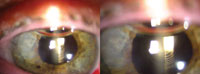 Figure 11. The premium IOL is seen through the clear cornea on day 1 after the procedure.