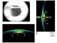 Figure 12. Day 1 after surgery, OCT images display uniform attachment of the Descemet’s membrane 