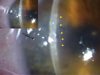 Figure 2. Composite slit-lamp photos show the detached Descemet’s membrane (arrows).