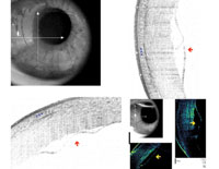 Figure 3. Preop OCT images displaying detached Descemet’s membrane (arrows), corneal stromal thickening secondary to stromal edema