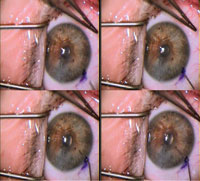 Figure 4. A 30-gauge cannula is introduced into the anterior chamber from a peripheral entry wound close to the limbus