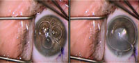 Figure 5. Air is steadily injected into the anterior chamber to result in a large air bubble, thus re-attaching the detached Descemet’s membrane. 