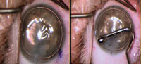 Figure 6. Folds in the attached Descemet’s membrane are clearly visible in the central cornea (left).