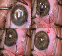 Figure 9. After 3 minutes, the cannula is reintroduced into the central region of the anterior chamber, and the air bubble size is decreased. 