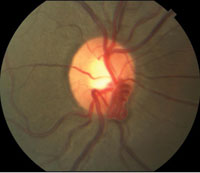 Figure 1. Fundus photos with close-up of optic nerves. Note temporal pallor of the left optic nerve and bilateral prepapillary vascular tufts.