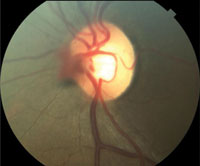 Figure 1. Fundus photos with close-up of optic nerves. Note temporal pallor of the left optic nerve and bilateral prepapillary vascular tufts.