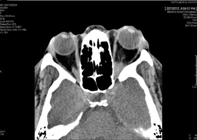 Figure 2. Orbital CT scan without contrast.