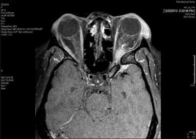 Figure 3. Orbital MRI showing T1 fat-suppressed window. 