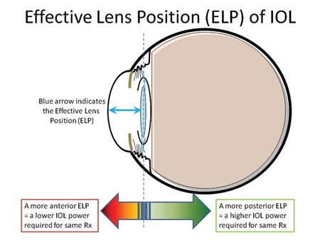 The effective lens position of the IOL determines the final postoperative refraction. If the IOL is more anteriorly placed, then a lower IOL power will be required, while a more posterior position will require a higher IOL power for the same postop refraction.