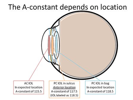 The A-constant of the IOL depends on its location within the eye. A more anteriorly placed lens such as an anterior chamber IOL (red) will have a lower A-constant than a posterior chamber IOL that is meant to be placed in the capsular bag (blue). When a lens is placed in an unexpected location, such as in the ciliary sulcus, the A-constant will change.