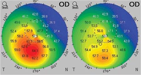 Improvement in corneal topography from preop to 1 year after CXL may lead to improvement in corneal and total ocular aberrations.