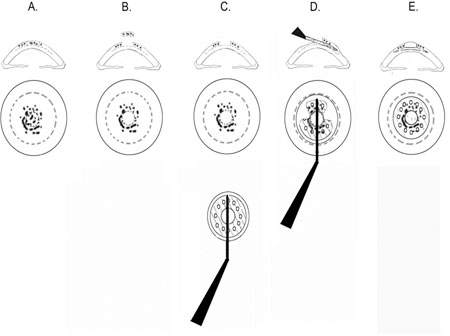 Figure 1. Schematic representation of artificial cornea surgery.