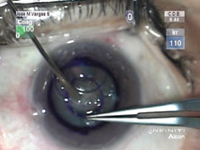 Figure 2. Intraoperative photograph of artificial cornea surgery.