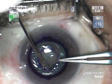 Figure 3. Intracorneal insertion of artificial cornea.