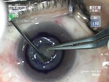 Figure 4. The rim is tucked into the corneal pocket.