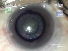 Figure 5. Completed view of the artificial cornea.