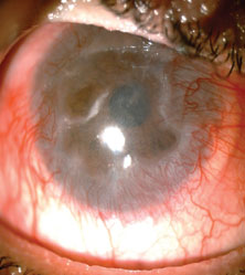 Figure 6. Preop and postop appearance of the cornea following artificial cornea surgery.