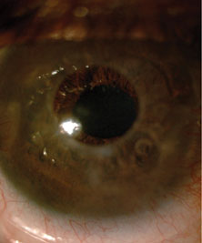 Figure 6. Preop and postop appearance of the cornea following artificial cornea surgery.