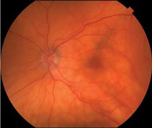 Figure 1a. Alternating yellow and dark lines (choroidal folds) in the macula extending temporally.