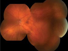 Figure 1b. Area of globe indentation in the temporal field of the left eye with overlying subretinal fluid and retinal pigment epithelium changes.