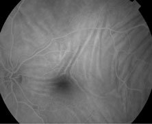 Figure 2a. Fluorescein angiography at 48 seconds, in the AV phase, showed no obvious leakage at the fovea or elsewhere.