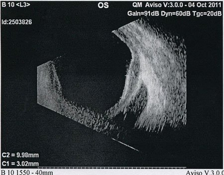 Figure 3. B-scan ultrasonography of the left eye was significant for scleral thickening and a well-defined homogenous hypoechoic lesion in the orbit apposed against the external surface of the inferior globe. 