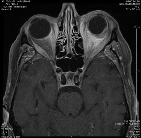 Figure 4. T1 fat-saturation MRI of the orbits showed minimal left proptosis and a left-side intraconal 