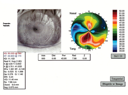 Preoperative topography. Following a corneal transplant, this patient had 11 D of topographic cylinder in the left eye and reduced BCVA.