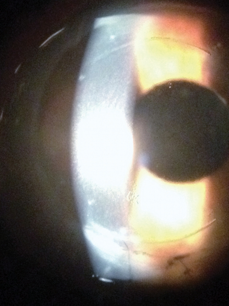 At the slit lamp, the femtosecond laser arcuate incisions look pristine and precise.