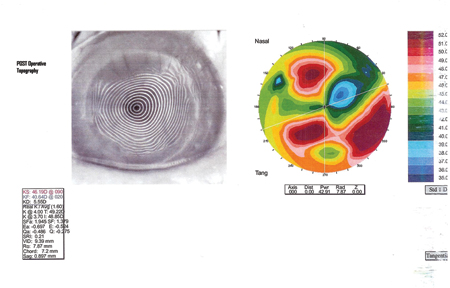 Postoperative topography shows somewhat more irregular astigmatism but a significant reduction in manifest astigmatism from 8 D preop to 3.25 D at 7 weeks postop.