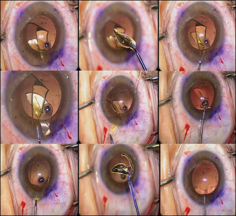 The three IOL optic segments are removed, while replenishing Viscoat in between IOL segment removal to protect both the posterior lens capsule and the corneal endothelium and to avoid any potential iris damage.