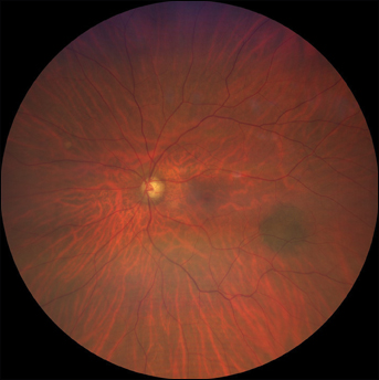 Choroidal nevus as seen with the Zeiss Clarus 500