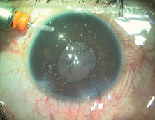 Patient with astigmatism