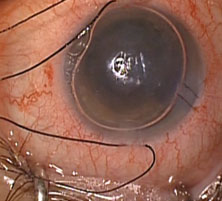 graft is unfolded and the anterior chamber is filled with air