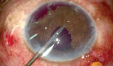 Pupillary stretching with end-opening forceps