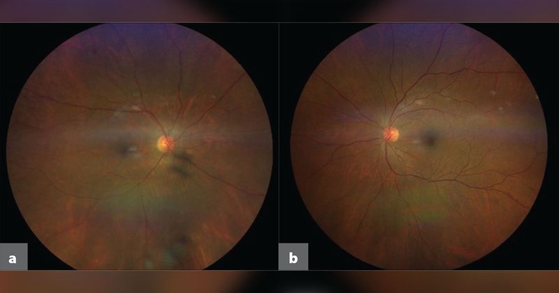 Fundus photographs of the right (a) and left eyes (b)