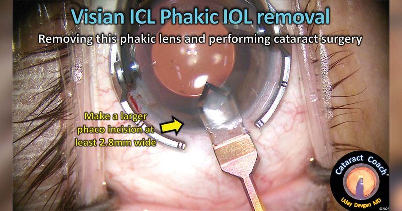 Make a larger 2.8-mm incision to facilitate removal of the posterior chamber phakic lens