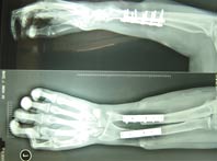 Postoperative radiographic image of bone shortening