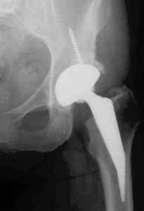 Figure 2: Conservative short hip stem