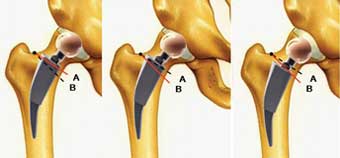 Figure 3: Femoral osteotomy and short-stem positioning