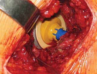 Figure 4: Intraoperative view of short-stem THR