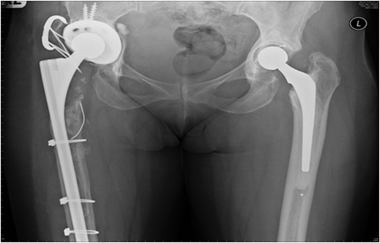 Failed total hip replacement