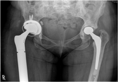 Constrained acetabular component