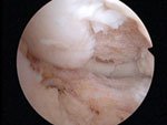 Lateral femoral condyle lesion