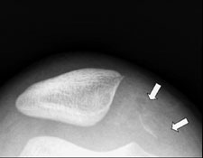 Patellar insertion medial patellofemoral ligament injury with an osteochondral avulsion fracture radiograph