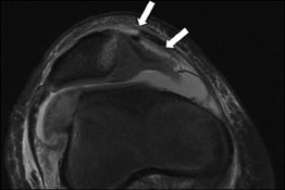 Patellar insertion medial patellofemoral ligament injury with an osteochondral avulsion fracture MRI