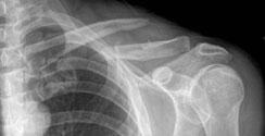 middle-third clavicle fracture