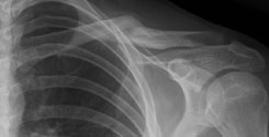 middle-third clavicle fracture