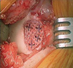 The cartilage autograft