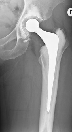 An Exeter hip is shown at 15 years postoperatively